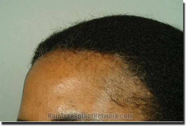 Hair restoration procedure results