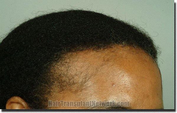 Hair restoration procedure results