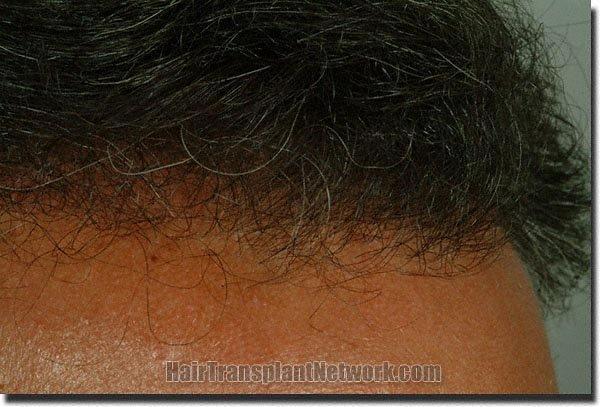 Hair restoration procedure results