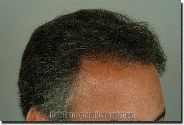 Hair restoration procedure results