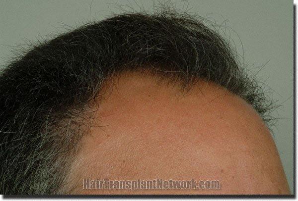 Hair restoration procedure results