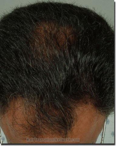 Hair restoration procedure results