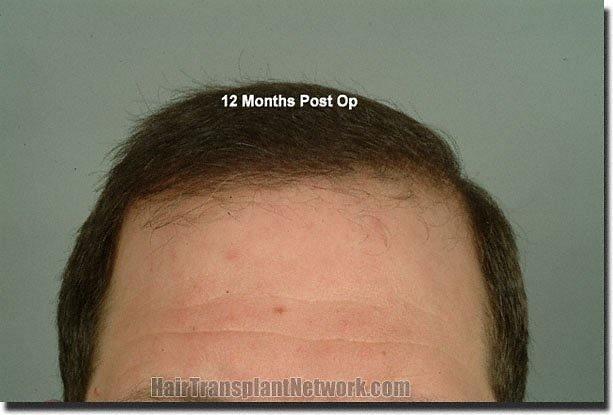 Hair restoration procedure results