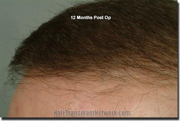 Hair restoration procedure results