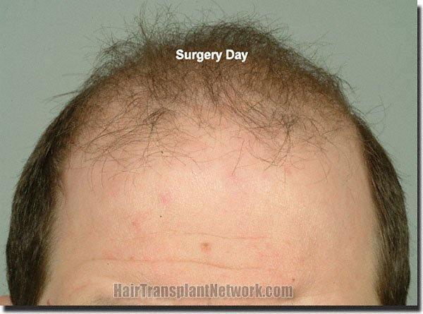 Hair restoration procedure results