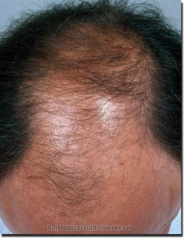 Hair restoration procedure results