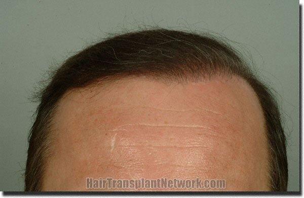 Hair restoration procedure results