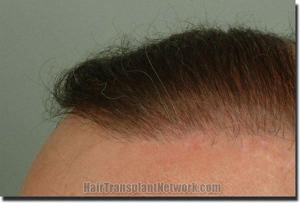 Hair restoration procedure results