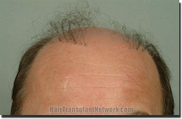 Hair restoration procedure results