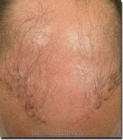 Hair restoration procedure results