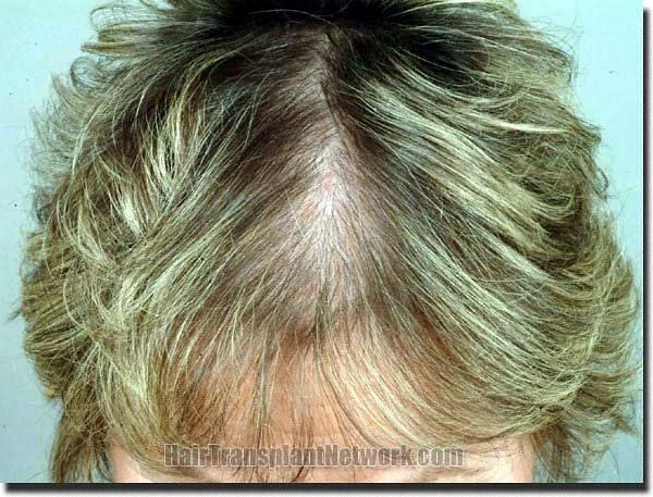 Hair restoration procedure results