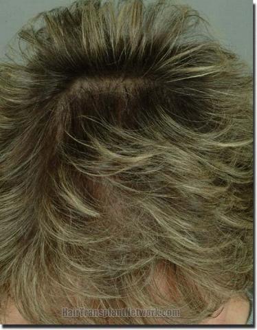 Hair restoration procedure results