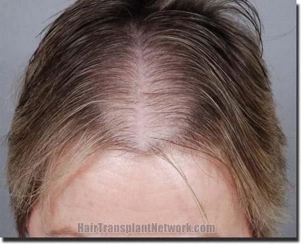 Hair restoration procedure results