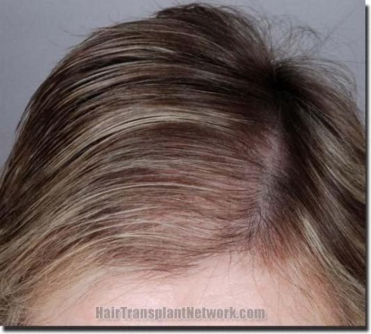 Hair restoration procedure results