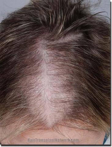 Hair restoration procedure results