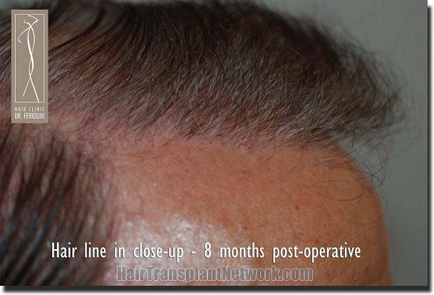 Hair restoration procedure results