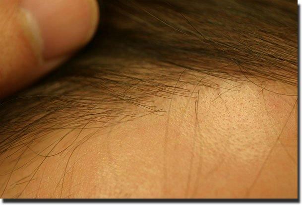 Hair restoration procedure results