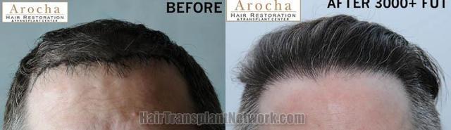 Hair restoration procedure before and after results