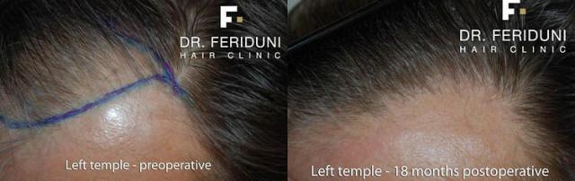 Hair restoration surgery before and after images