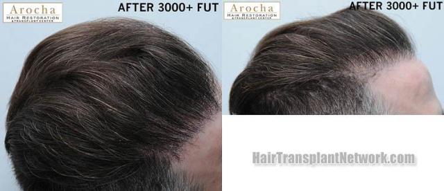 Hair transplantation surgery before and after images