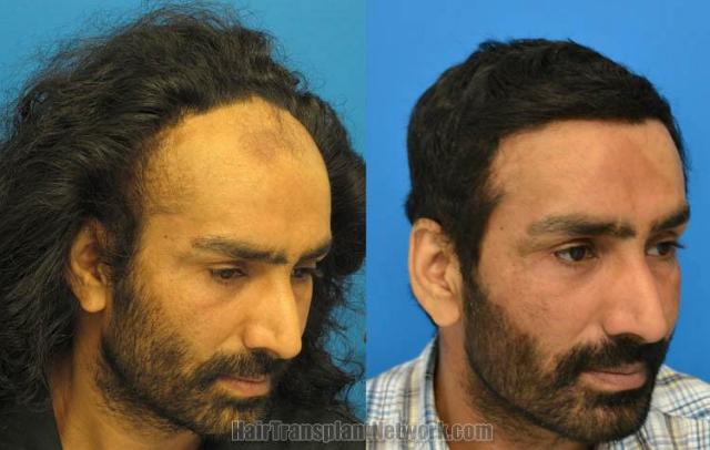 Hair restoration procedure before and after pictures