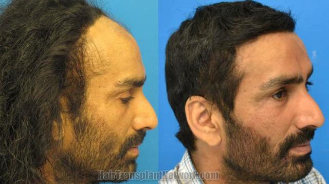 Hair transplantation surgery before and after images