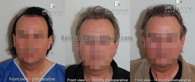 Hair restoration procedure before and after results