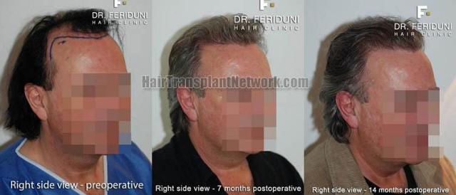 Hair restoration surgery before and after photos