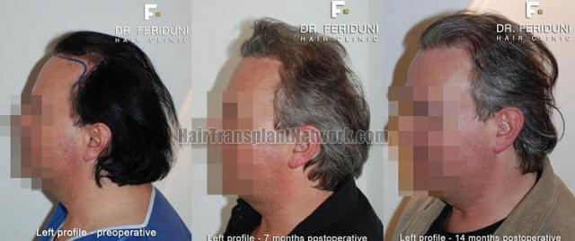 Hair transplantation surgery before and after pictures