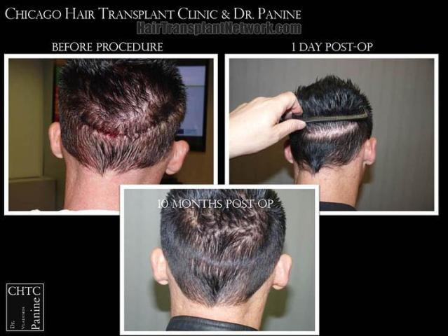 Hair restoration procedure before and after pictures