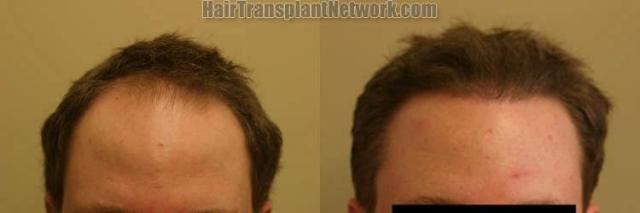 Hair restoration procedure before and after results