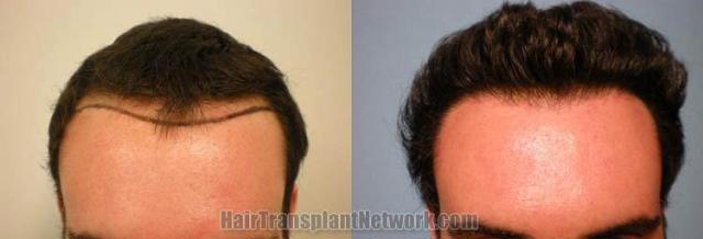 Hair transplantation surgery before and after images