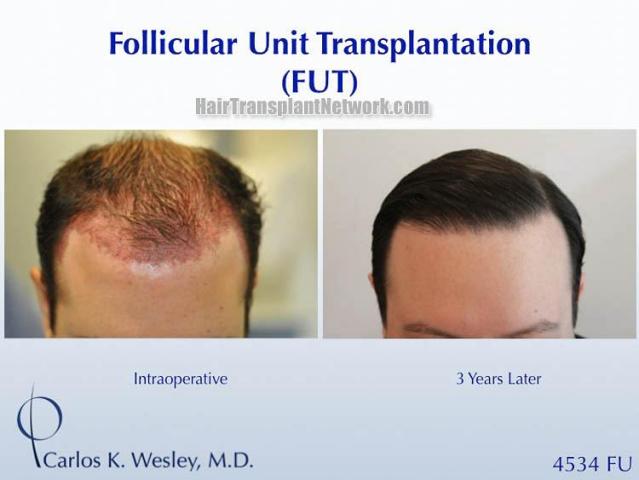 Hair transplant surgery before and after images