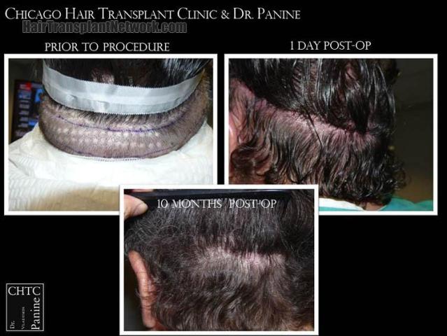 Hair restoration procedure before and after pictures