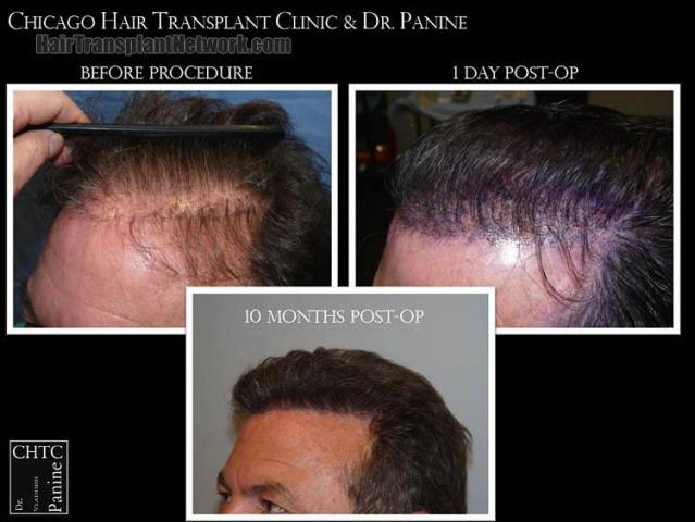 Hair transplantation surgery before and after pictures