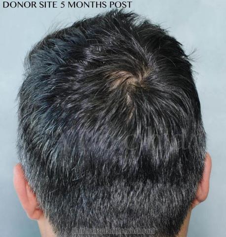 Hair restoration surgery before and after photos