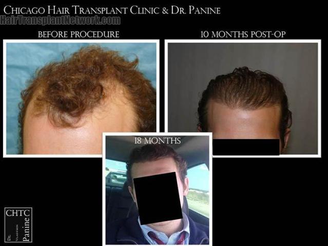 Hair restoration procedure before and after pictures