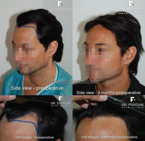 Hair transplantation surgery before and after pictures