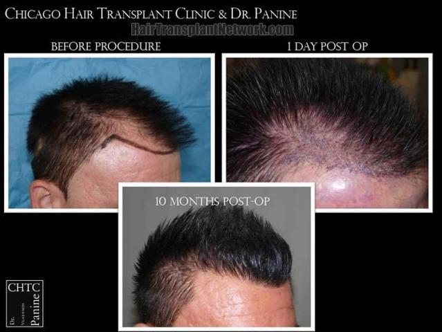 Hair transplantation surgery before and after images