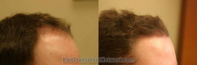 Hair transplantation surgery before and after images