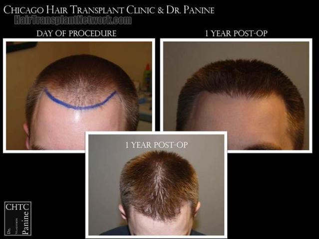 Top view - Before and after surgical hair replacement