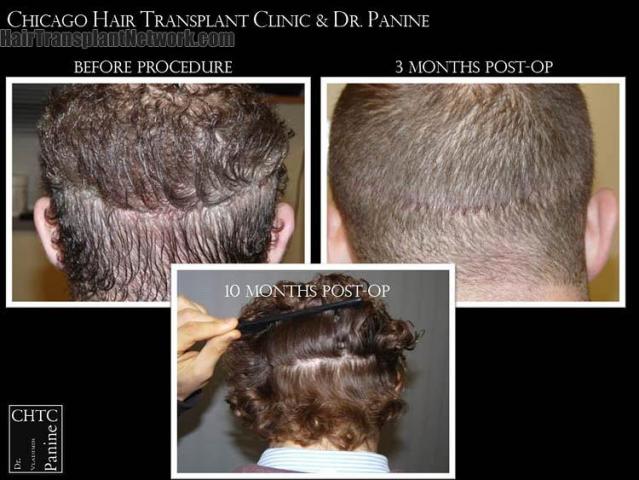 Hair transplantation surgery before and after pictures