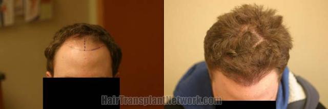 Hair transplantation surgery before and after photos