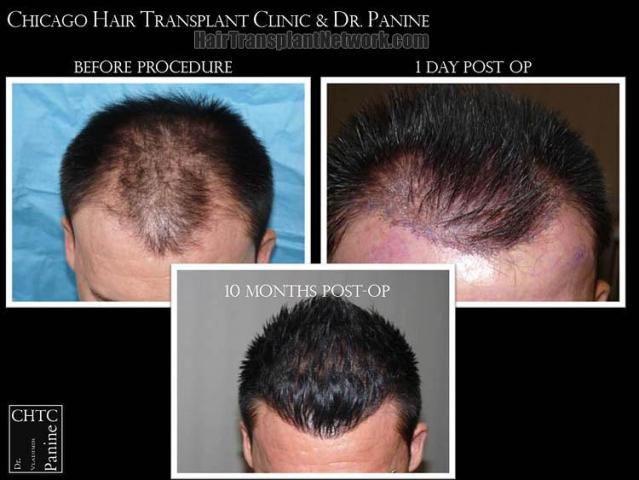 Hair transplantation surgery before and after photos