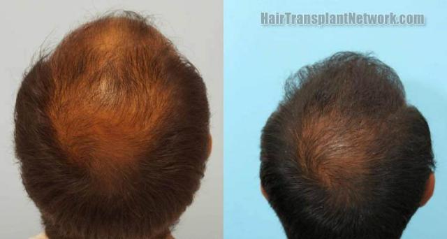 Hair transplantation surgery before and after pictures