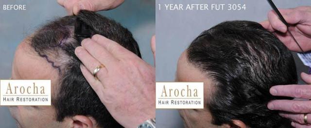 Hair transplantation surgery before and after photos