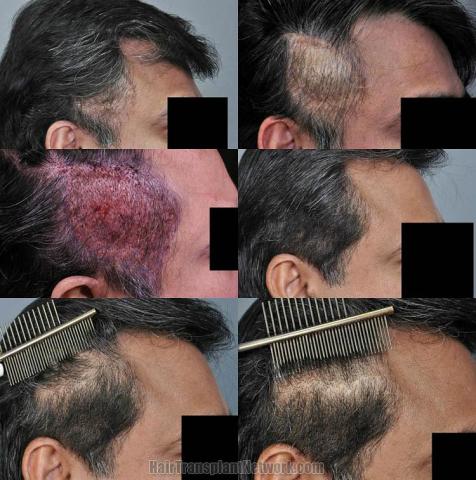 Hair transplantation surgery before and after pictures