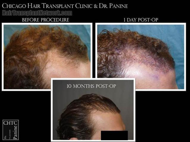 Hair transplantation surgery before and after photos