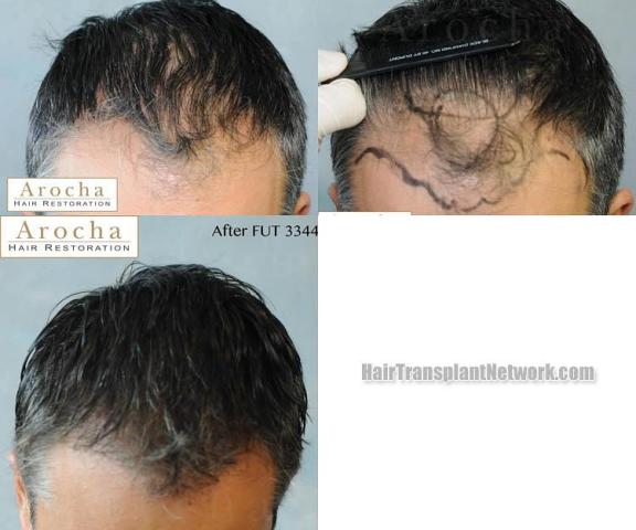 Hair restoration procedure before and after results