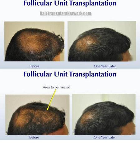 Hair restoration procedure before and after results